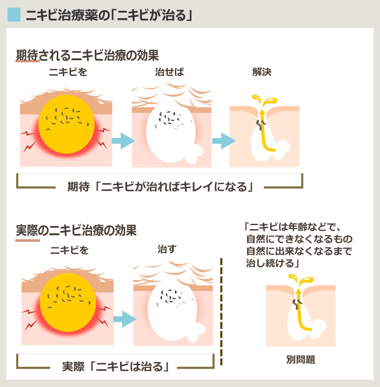 薬に頼らずニキビを治したい-ニキビ治療の誤解と現実