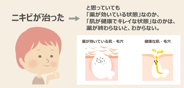 薬に頼らずニキビを治したい-ニキビ治療とニキビ解決は別問題
