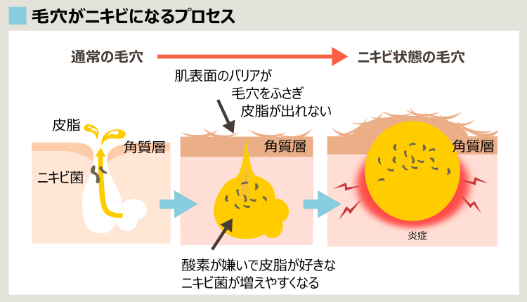 ニキビができる過程