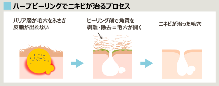 ハーブピーリングのニキビ治療効果やメリット