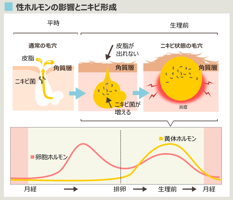 生理周期とニキビ形成の関連