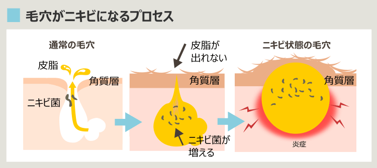 大人ニキビができる原因と過程