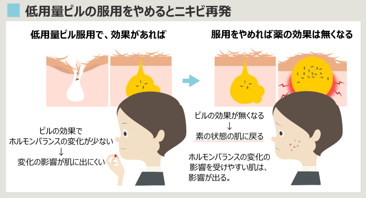 低用量ピルの服用を止めたら、ニキビが再発する理由