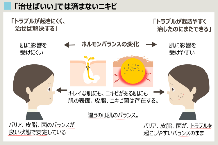 ニキビが完治しない理由