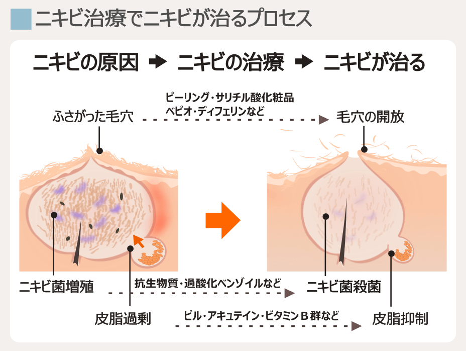 大人ニキビでよく行われる治療法