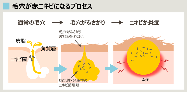 赤ニキビができるプロセス