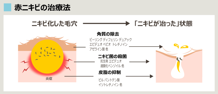 皮膚科での赤ニキビ治療と効果の解説