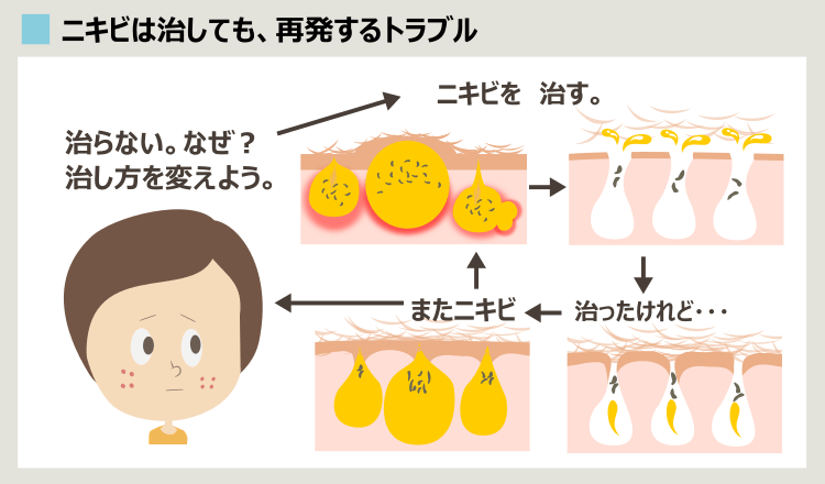 赤ニキビ治療が治らない原因の理解