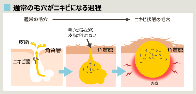 ニキビができる原因