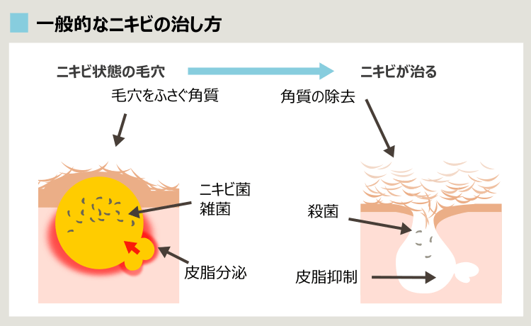 ニキビを治す方法の俯瞰図