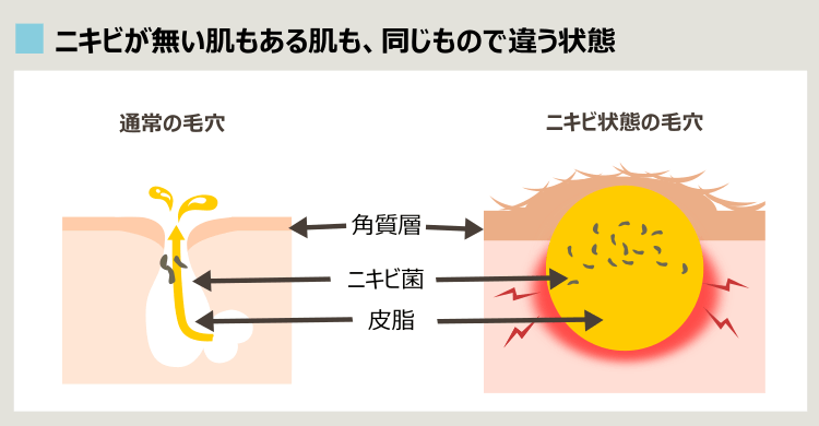 ニキビのある肌とない肌は同じものでできている