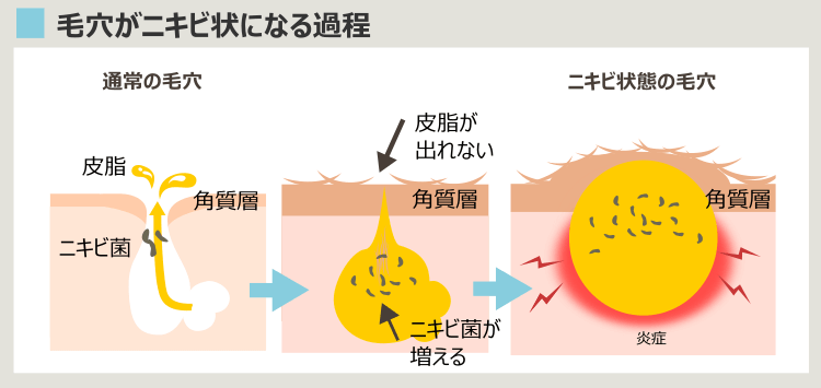 毛穴がニキビになる過程