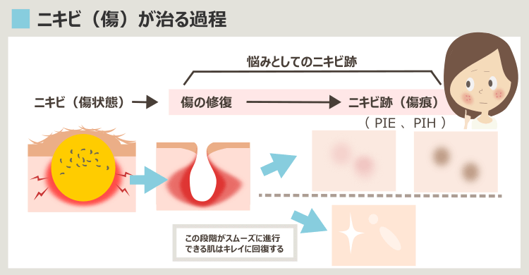 ニキビ跡の赤みを解説