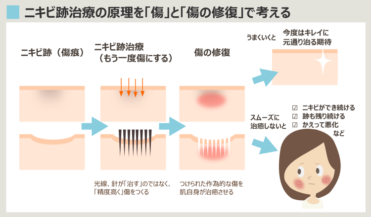 ニキビ跡治療でも治らない理由