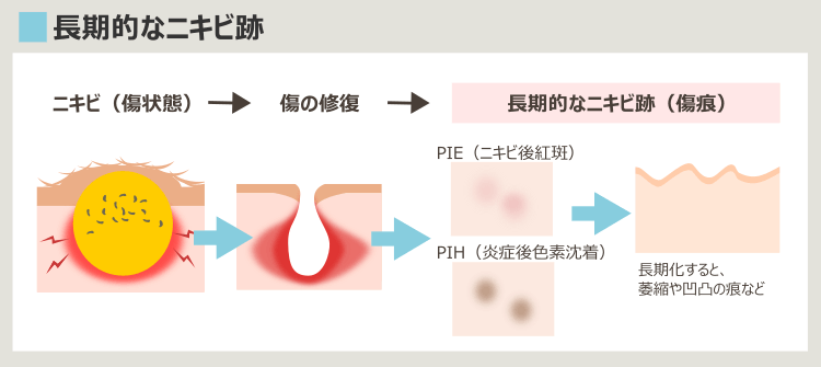 さらに詳細なニキビ跡の解説