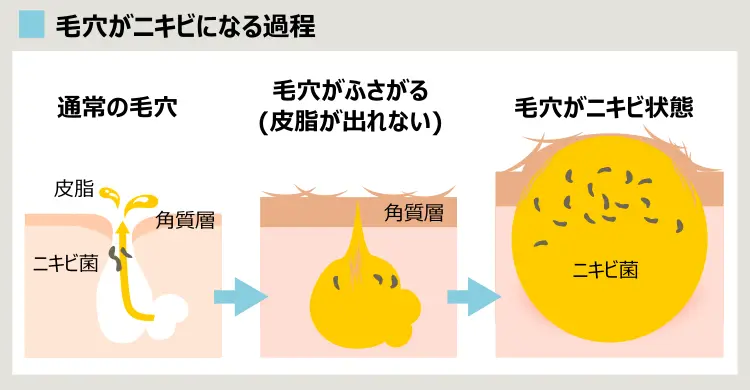 毛穴がニキビ状態になるプロセス