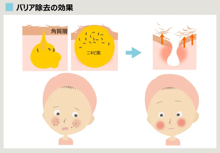 古い角質を除去すればニキビは治る