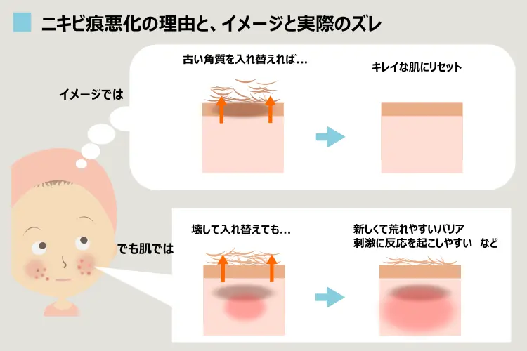 ハーブピールでニキビ痕が悪化する理由の解説