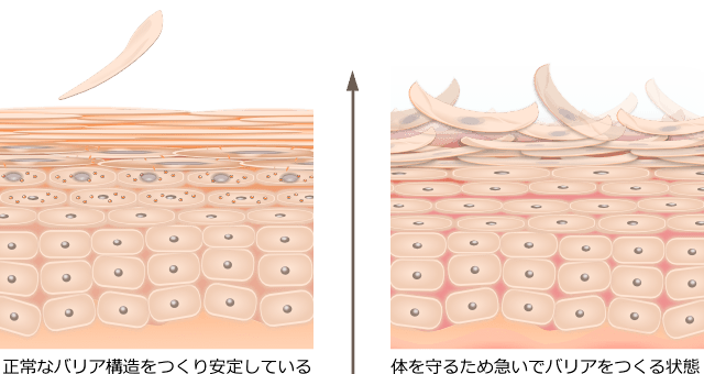 表皮ターンオーバーの異常