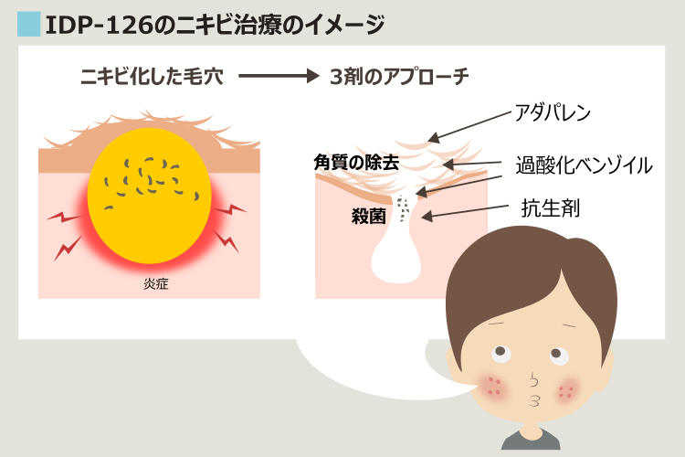 IDP-126のニキビ治療効果の解説