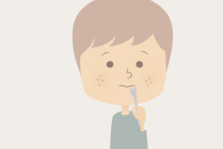 インド医師-食事とニキビの関連を解説