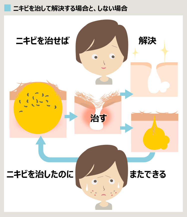 ニキビを治しても治らない