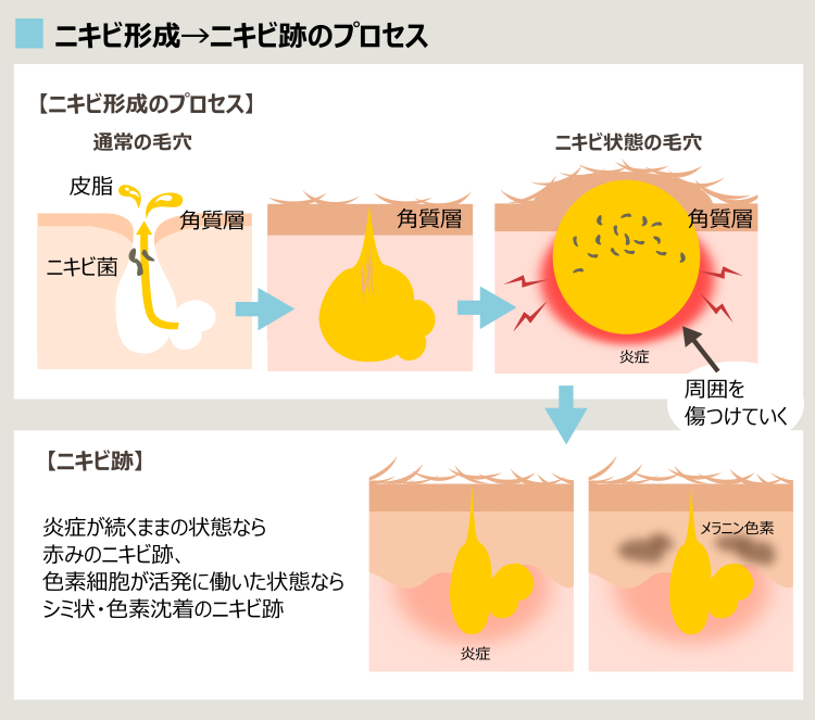 IPLでも治らないニキビとニキビ跡のプロセス