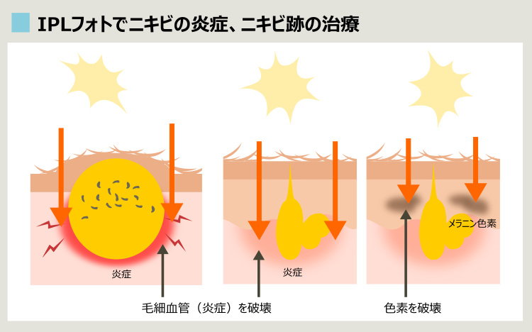 IPLで治るニキビやニキビ跡の色素沈着