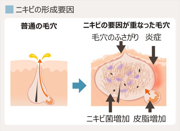 フェイスラインニキビの形成要因