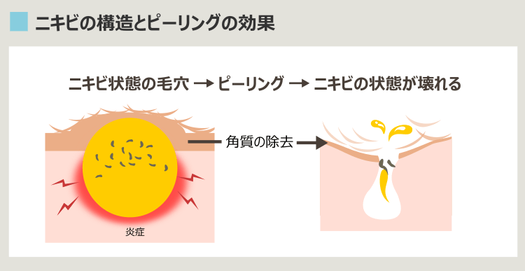 乳酸ピーリングでニキビが治る