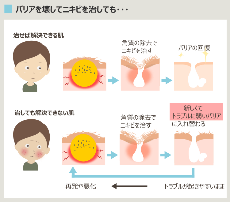 乳酸ピーリングでニキビが治らない理由