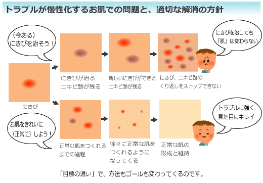 ニキビ治療、ニキビエステと、根本的解決法の違い