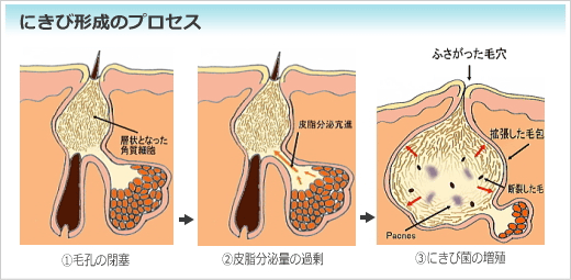 ニキビ形成機序