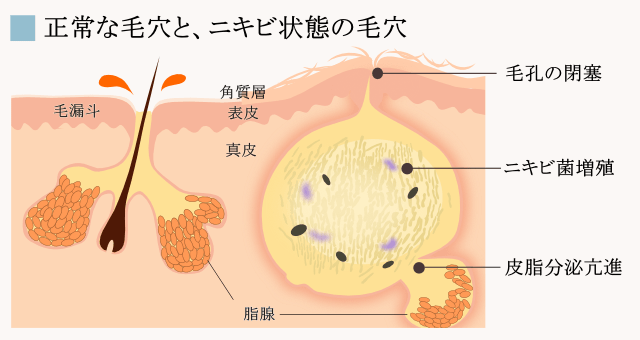 normal_skin-acne_skin