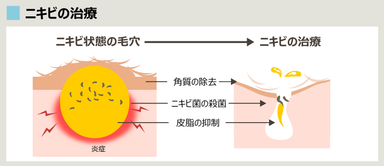 保険適用、保険適用外のニキビ治療に共通する前提