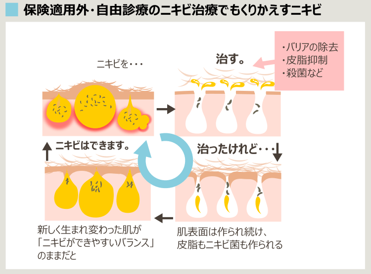 自由診療のニキビ治療で治っても、すぐに再発するメカニズム