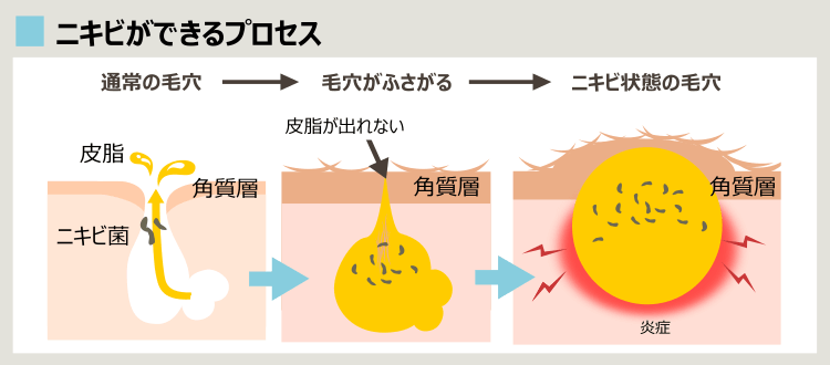 毛穴がニキビに変化するプロセス