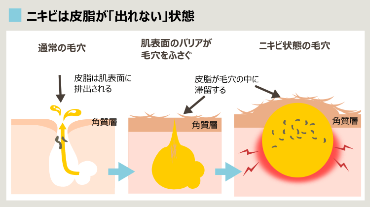 塗布する油分ではなく、出れない皮脂がニキビの要因