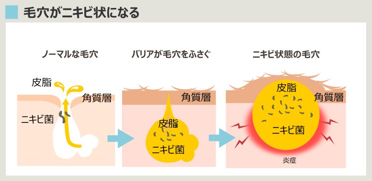 ニキビができるまでの毛穴の経過