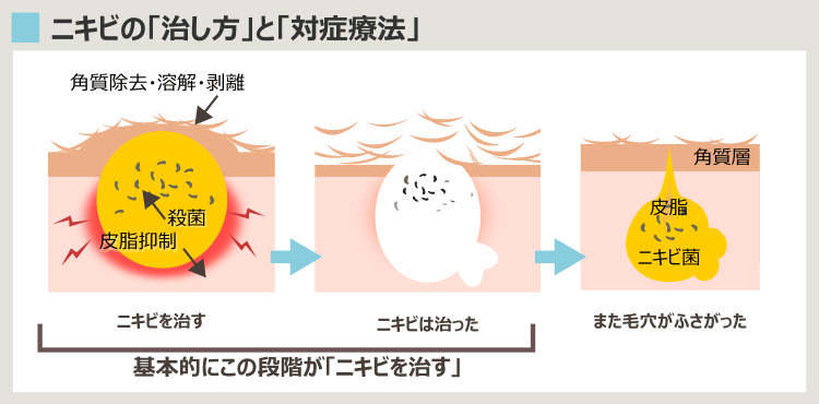 様々なニキビ治療と、その効果