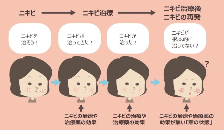 自分に合うニキビ治療で生じやすい誤解