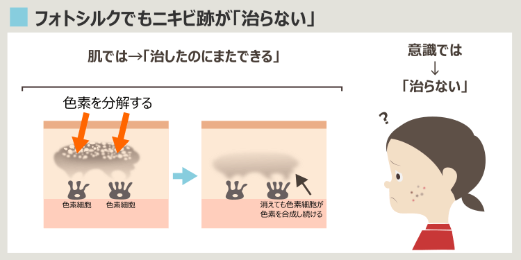 フォトシルクプラスでもニキビ痕が消えない理由