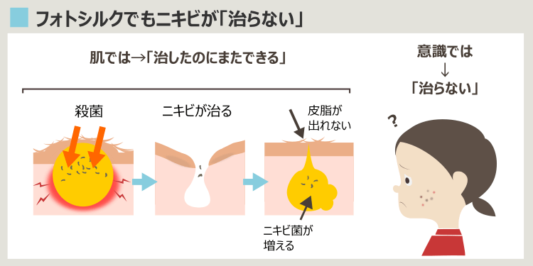 フォトシルクプラスでもニキビが治らない理由