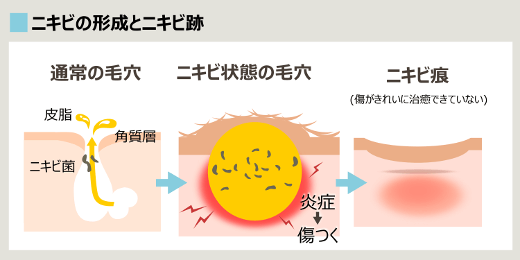 ニキビがニキビ跡になる過程