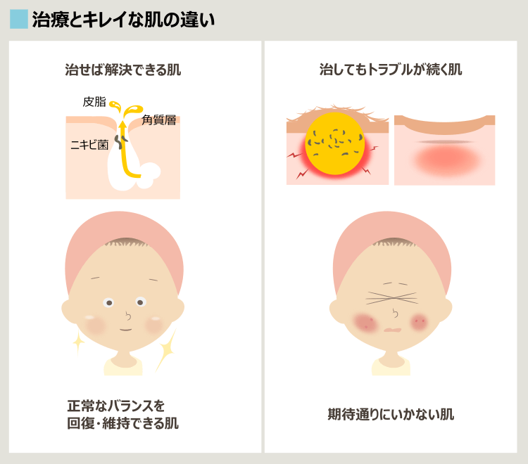 ピコシュアでもニキビが続き、跡が残る理由