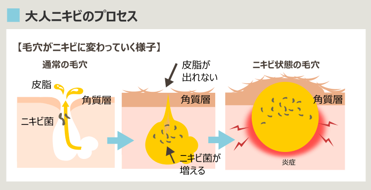 大人ニキビのプロセス