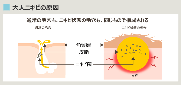 大人ニキビの原因