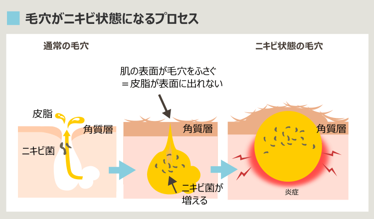 ニキビ形成機序