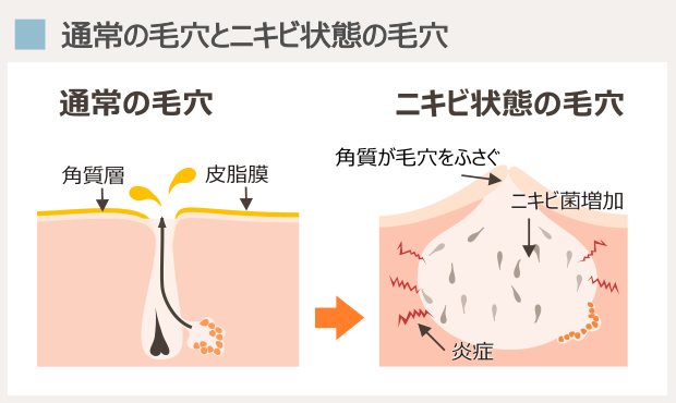 通常の毛穴とニキビ状態の毛穴