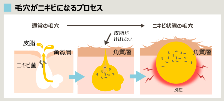 ニキビ形成プロセス